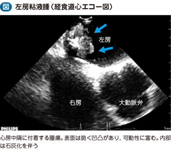 04_47_原発性心臓腫瘍（良性）