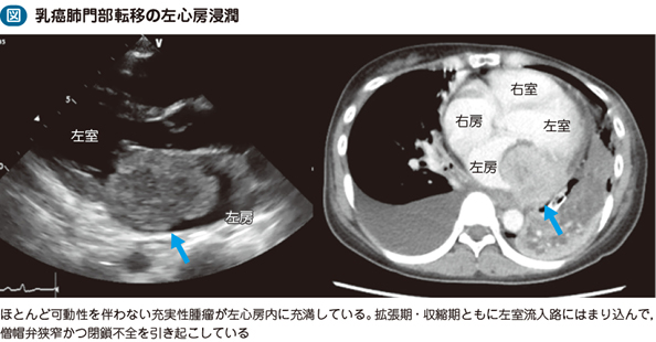 04_49_転移性心臓腫瘍