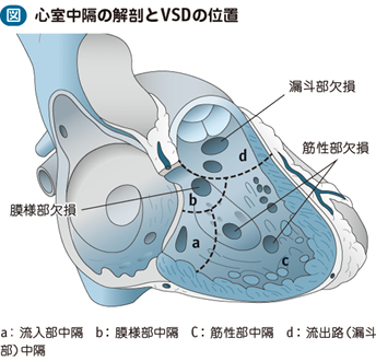 04_50_心室中隔欠損症