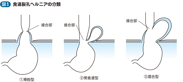 05_05_食道裂孔ヘルニア