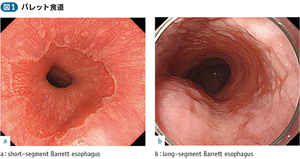 05_09_バレット食道