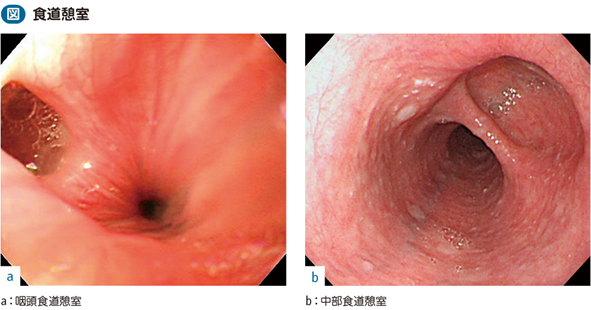 05_13_食道憩室