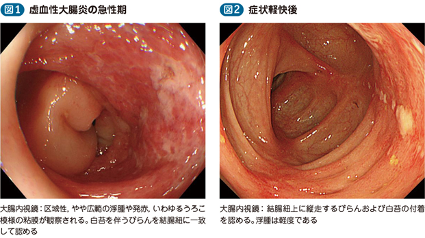 血性 炎 虚 大腸