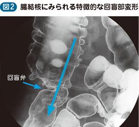 05_37_腸結核