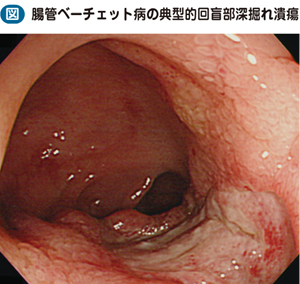 05_39_腸管ベーチェット病