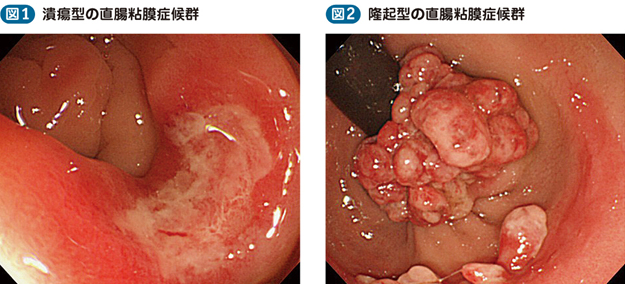 05_42_直腸粘膜脱症候群