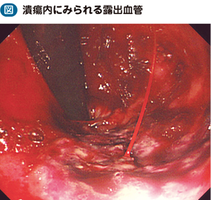 05_43_急性出血性直腸潰瘍