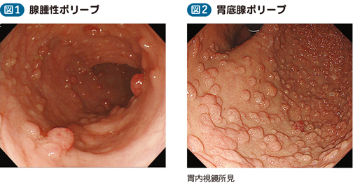 05_47_家族性大腸腺腫症