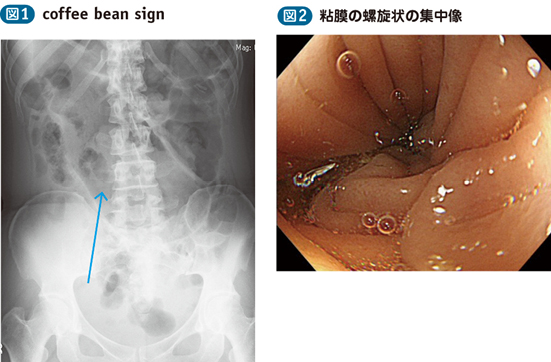 05_55_腸軸捻転