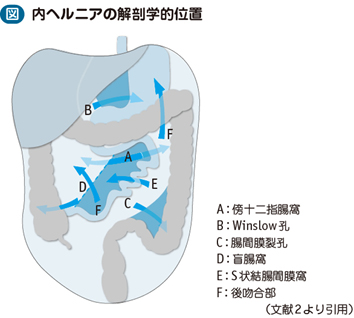 05_68_内ヘルニア