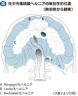 05_69_横隔膜ヘルニア