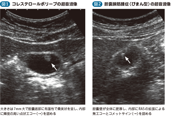 06_19_胆嚢ポリープ・胆嚢腺筋腫症