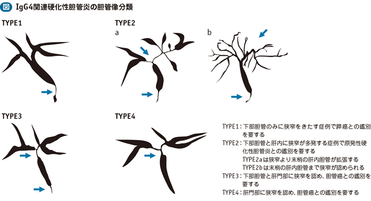 06_24_IgG4関連硬化性胆管炎