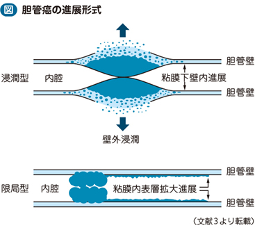 06_25_肝外胆管癌