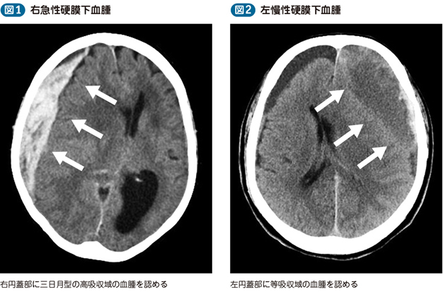 膜 血腫 硬 下