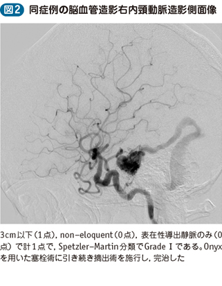 08_08_脳動静脈奇形（AVM）