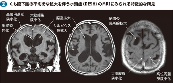 08_10_特発性正常圧水頭症