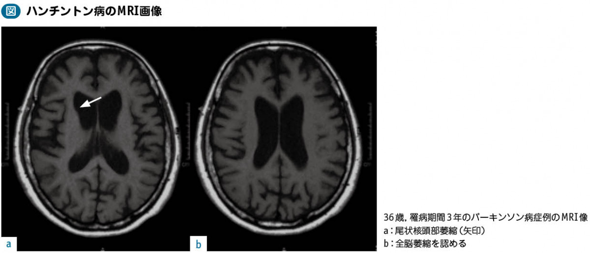 08_19_ハンチントン病