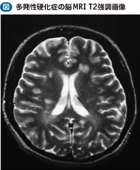08_37_多発性硬化症（MS）