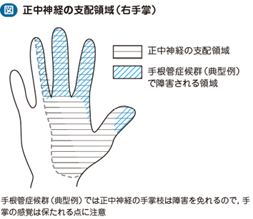 08_43_圧迫性ニューロパチー（手根管症候群など…）