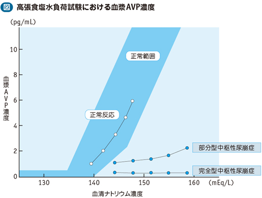 10_04_中枢性尿崩症