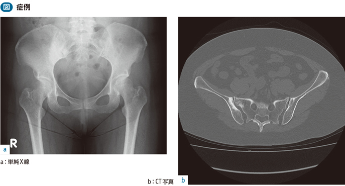 11_09_脊椎関節炎（強直性脊椎炎…）