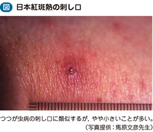 12_40_日本紅斑熱