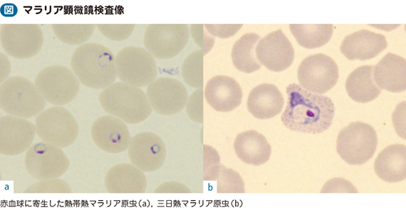 13_02_マラリア