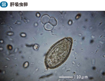 13_12_肝吸虫症