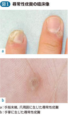 ウイルス性疣贅 尋常性疣贅など 電子コンテンツ 日本医事新報社