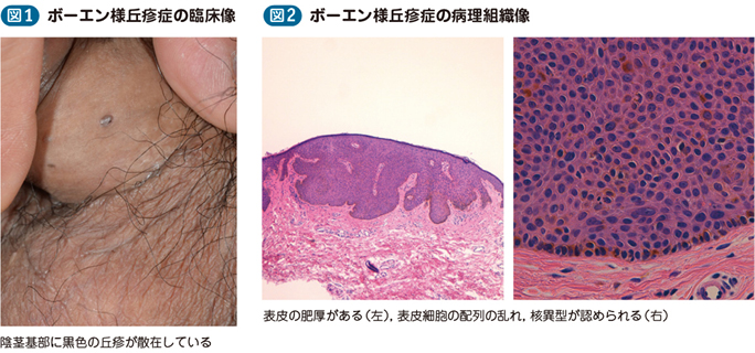 ウイルス性疣贅 ボーエン様丘疹症 電子コンテンツ 日本医事新報社