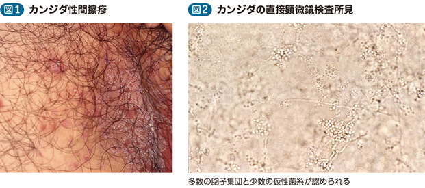 皮膚 カンジダ 症