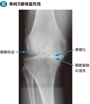 15_02_変形性膝関節症