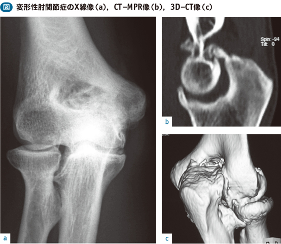 15_03_変形性肘関節症