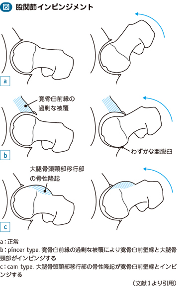 股関節インピンジメント 大腿骨寛骨臼インピンジメント 電子コンテンツ 日本医事新報社