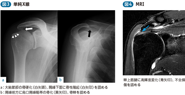 肩関節インピンジメント症候群 電子コンテンツ 日本医事新報社