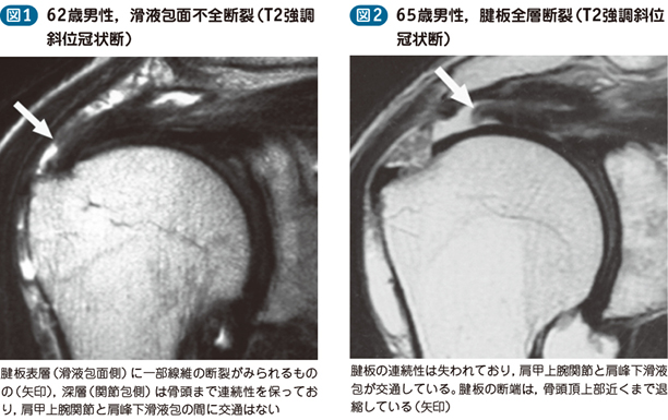 15_14_肩腱板損傷