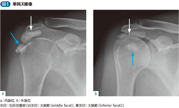 15_15_肩石灰沈着性腱炎