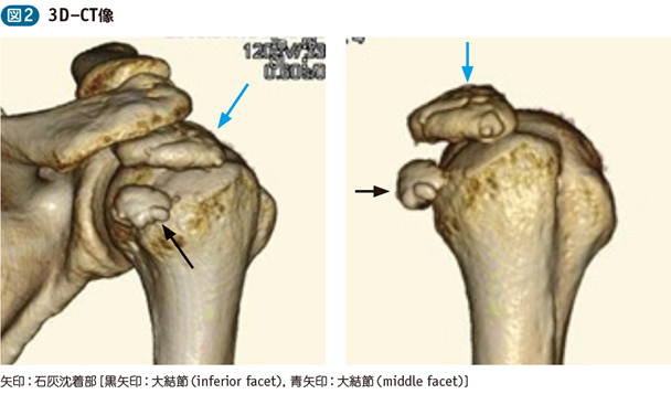 15_15_肩石灰沈着性腱炎