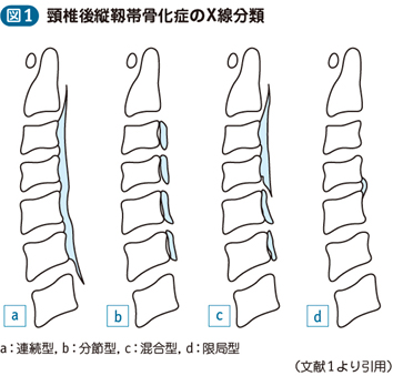 15_18_頸椎後縦靱帯骨化症