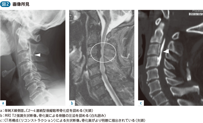 骨 化 症 十字 靭帯 後