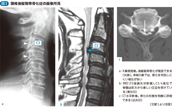 後縦靱帯骨化症 黄色靱帯骨化症 電子コンテンツ 日本医事新報社