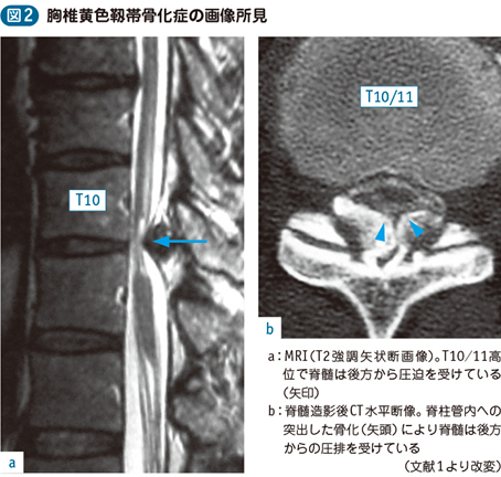 後縦靱帯骨化症 黄色靱帯骨化症 電子コンテンツ 日本医事新報社