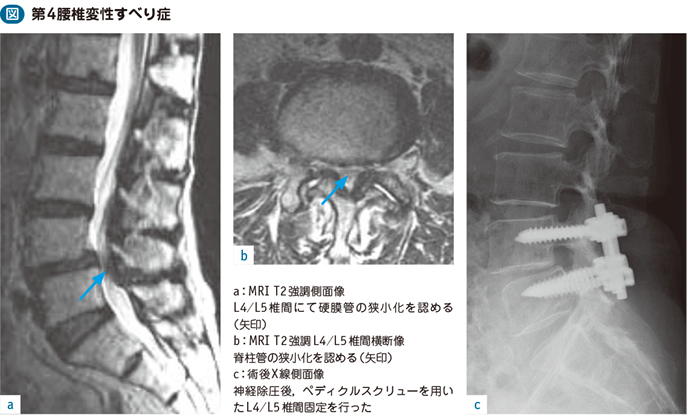 15_30_腰椎変性すべり症