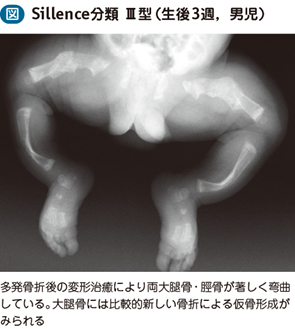 15_39_骨形成不全症