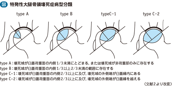 15_40_大腿骨頭壊死症