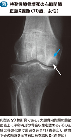 15_41_特発性膝骨壊死