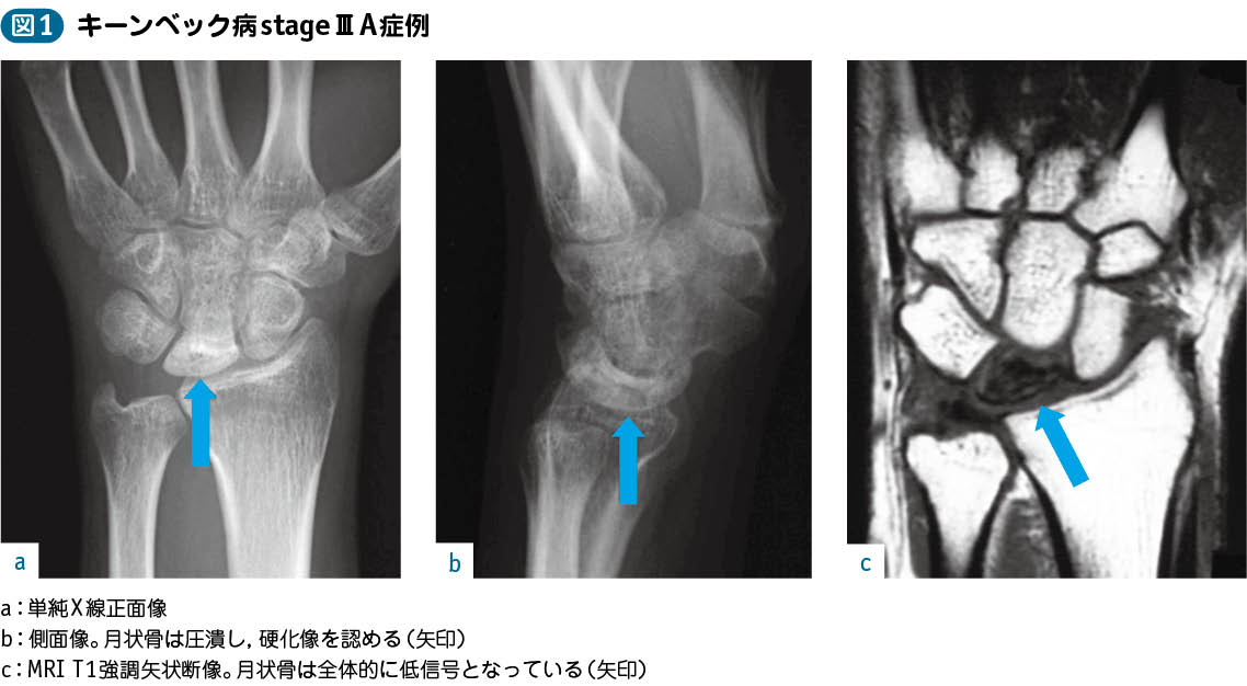 15_49_キーンベック病