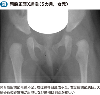 15_54_発育性股関節形成不全・先天性股関節…