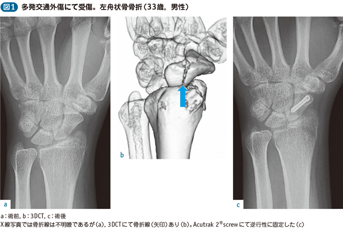 15_61_舟状骨骨折